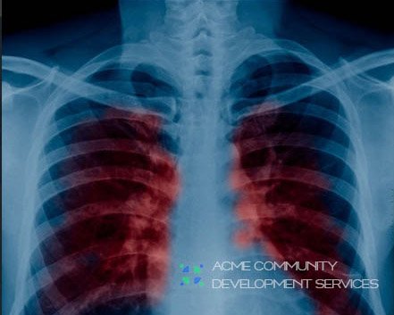 Tuberculosis Resurges as World’s Top Infectious Killer: WHO Urges Action